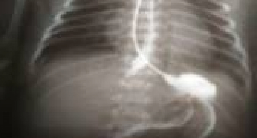 В Волгограде хирурги провели уникальную операцию новорождённой девочке