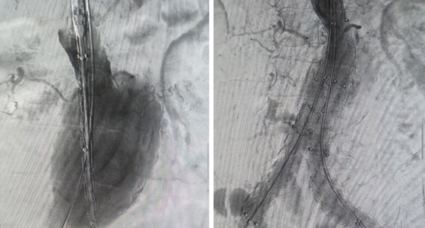 Волгоградские хирурги сделали мужчине сложнейшую операцию на аорте без разрезов